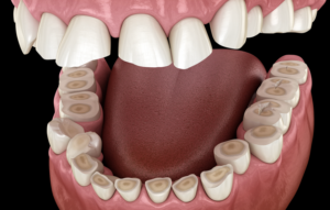 Dentist-Toa-Payoh-Teeth-Grinding